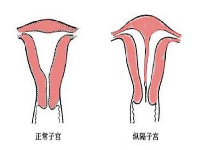 纵隔子宫怀孕了能要吗，胎儿会不会畸形？