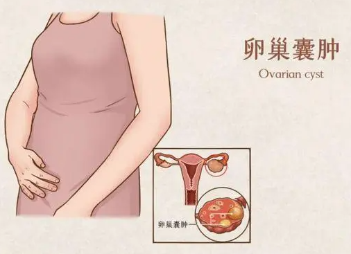卵巢囊肿按压腹部会痛吗？