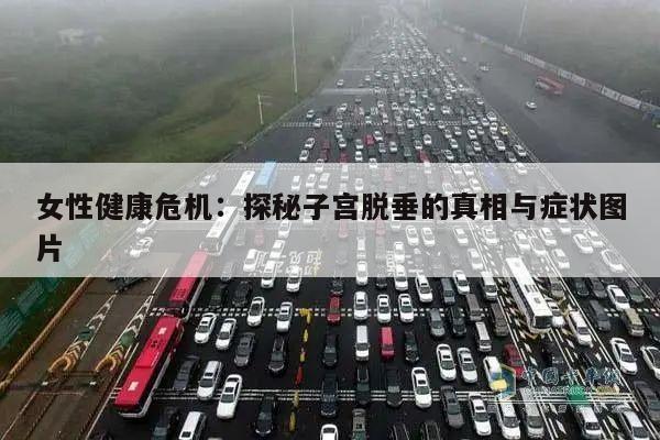 女性健康危机：探秘子宫脱垂的真相与症状图片