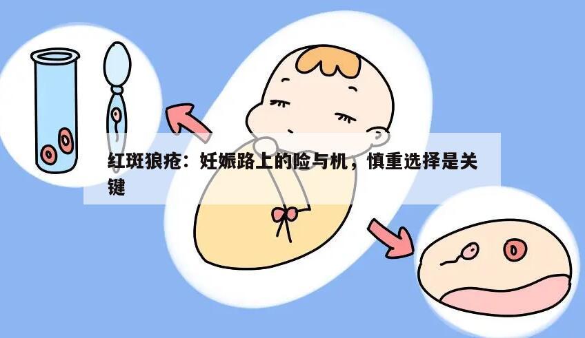 红斑狼疮：妊娠路上的险与机，慎重选择是关键