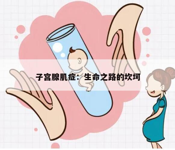 子宫腺肌症：生命之路的坎坷