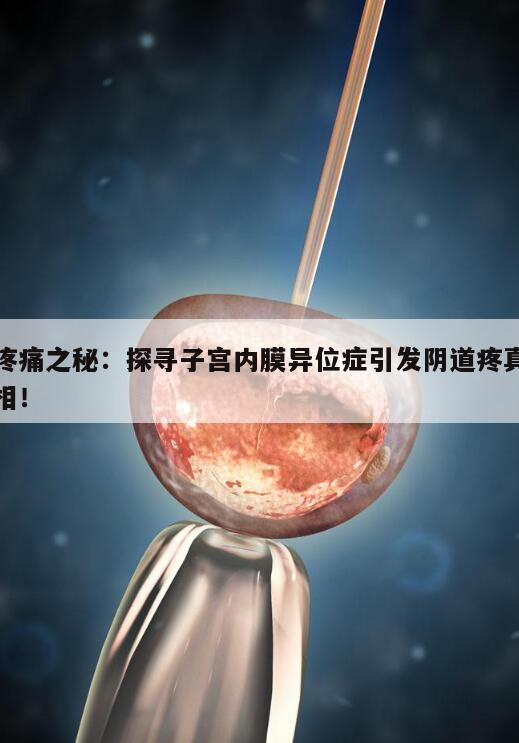 疼痛之秘：探寻子宫内膜异位症引发阴道疼真相！