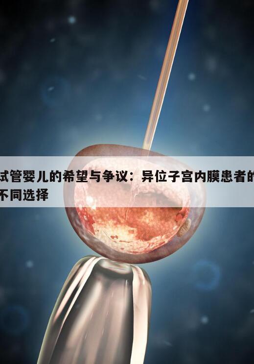试管婴儿的希望与争议:异位子宫内膜患者的不同选择