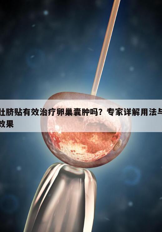 肚脐贴有效治疗卵巢囊肿吗?专家详解用法与效果