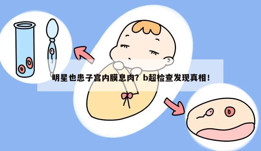 明星也患子宫内膜息肉？b超检查发现真相！